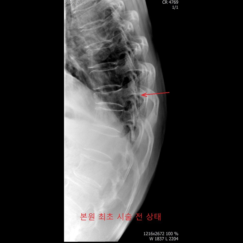 본원 최초 시술 전