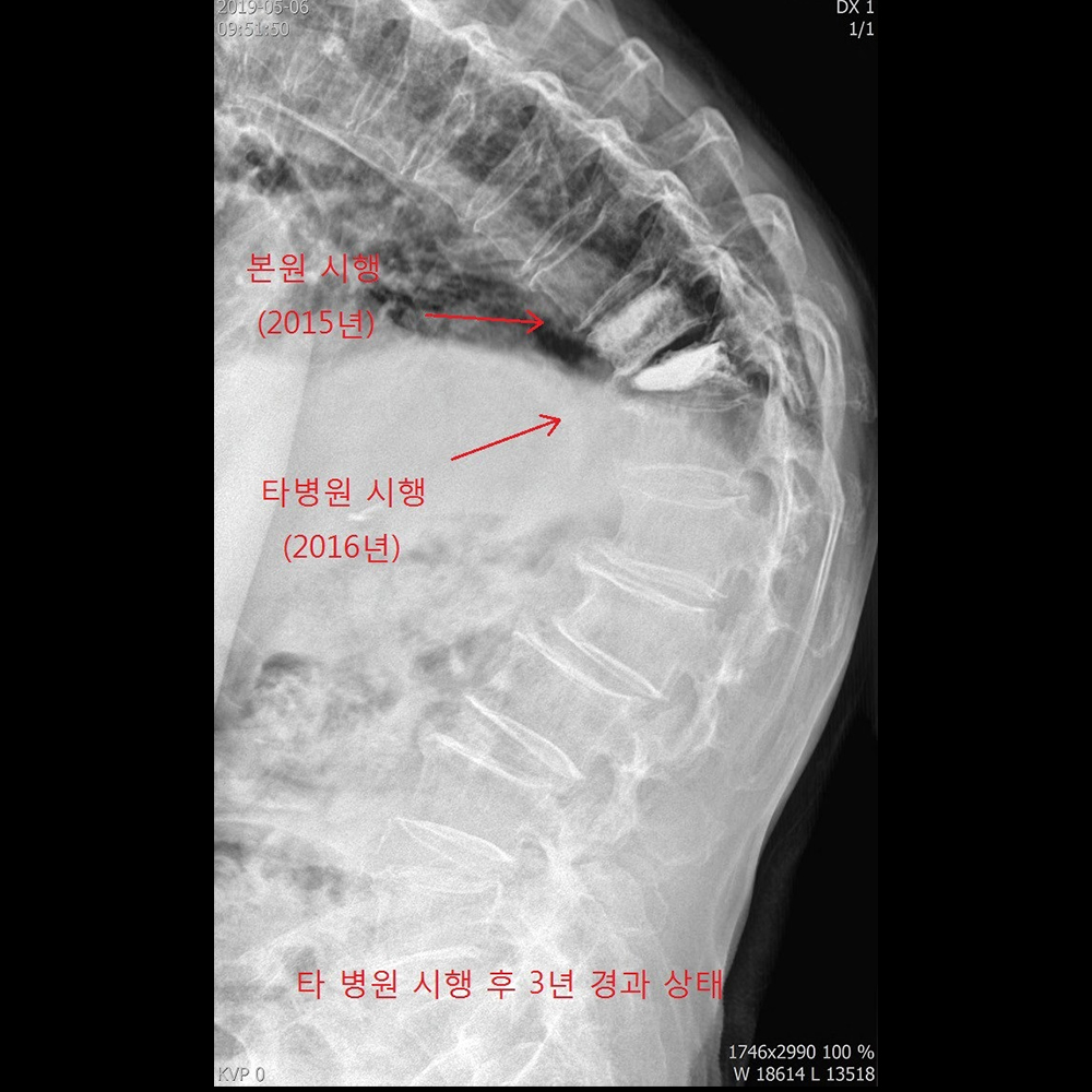타원 시술 후 3년 경과 상태 측면