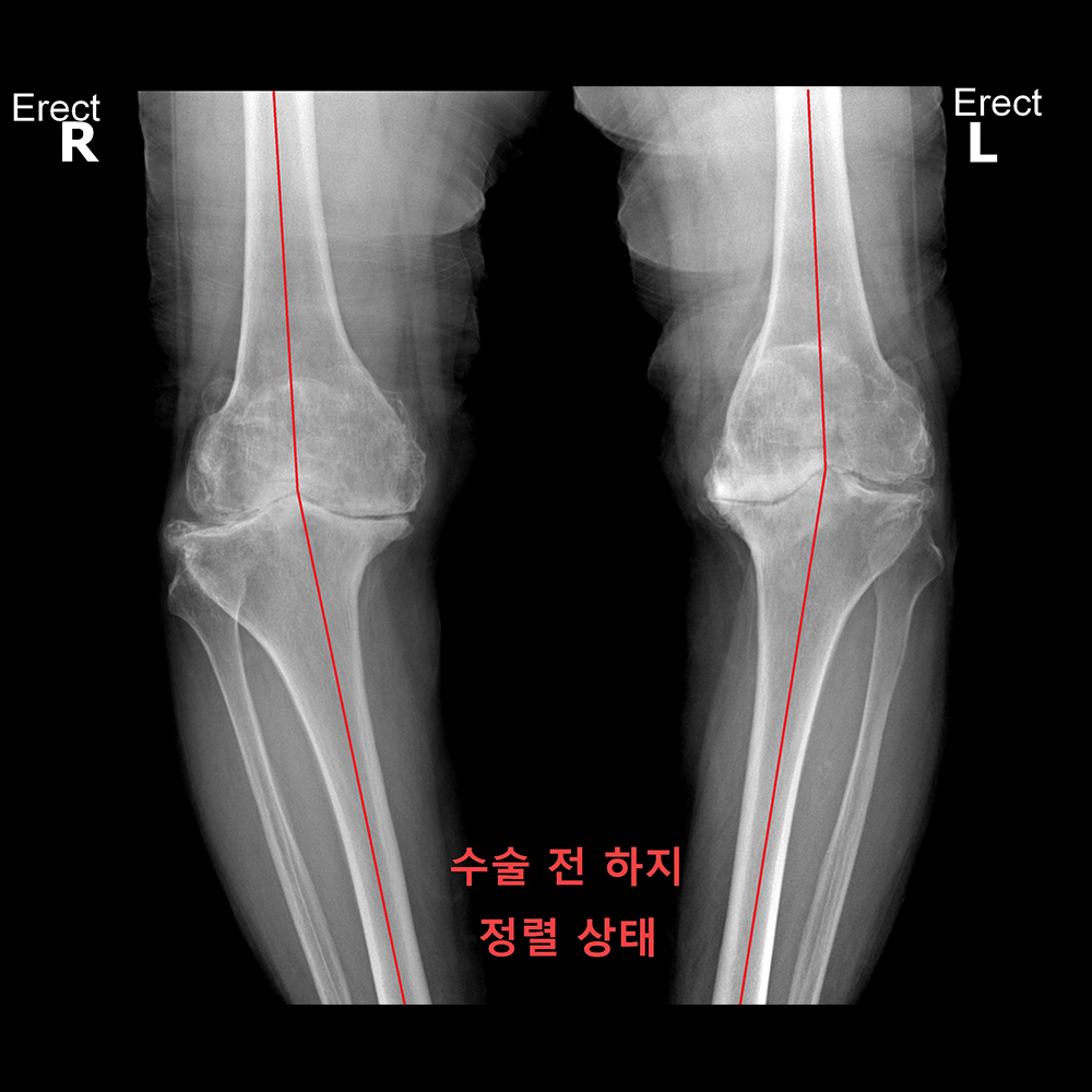 수술 전 하지 정렬 상태
