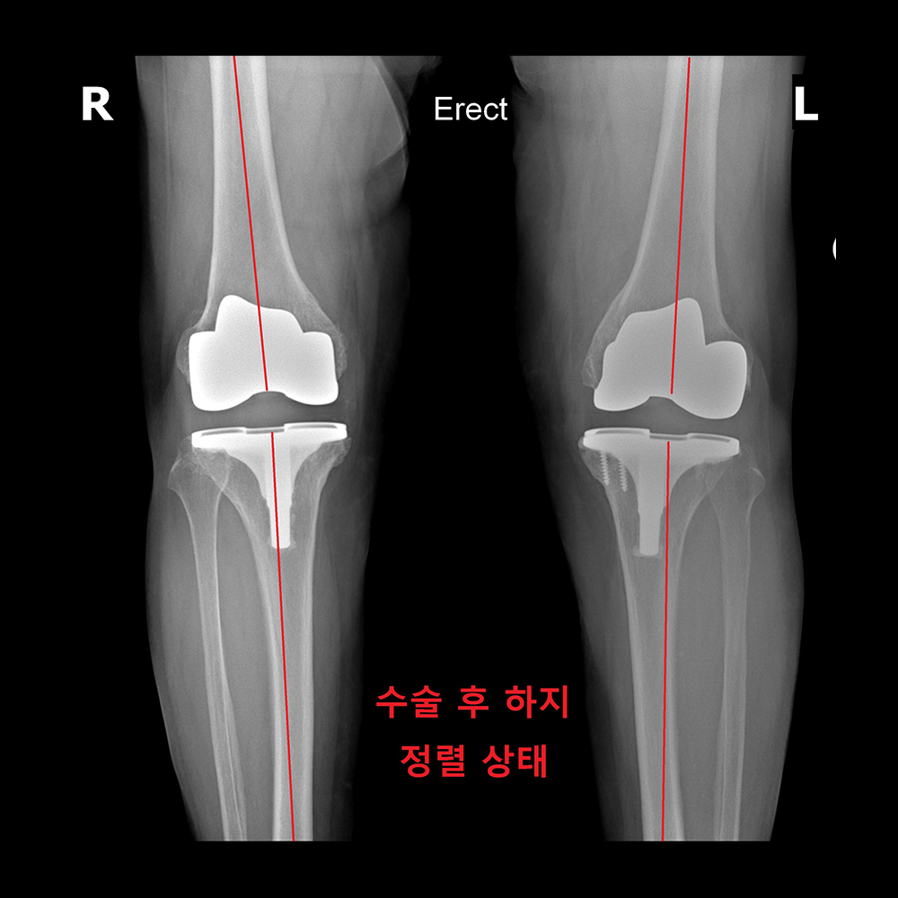 수술 후 하지 정렬 상태
