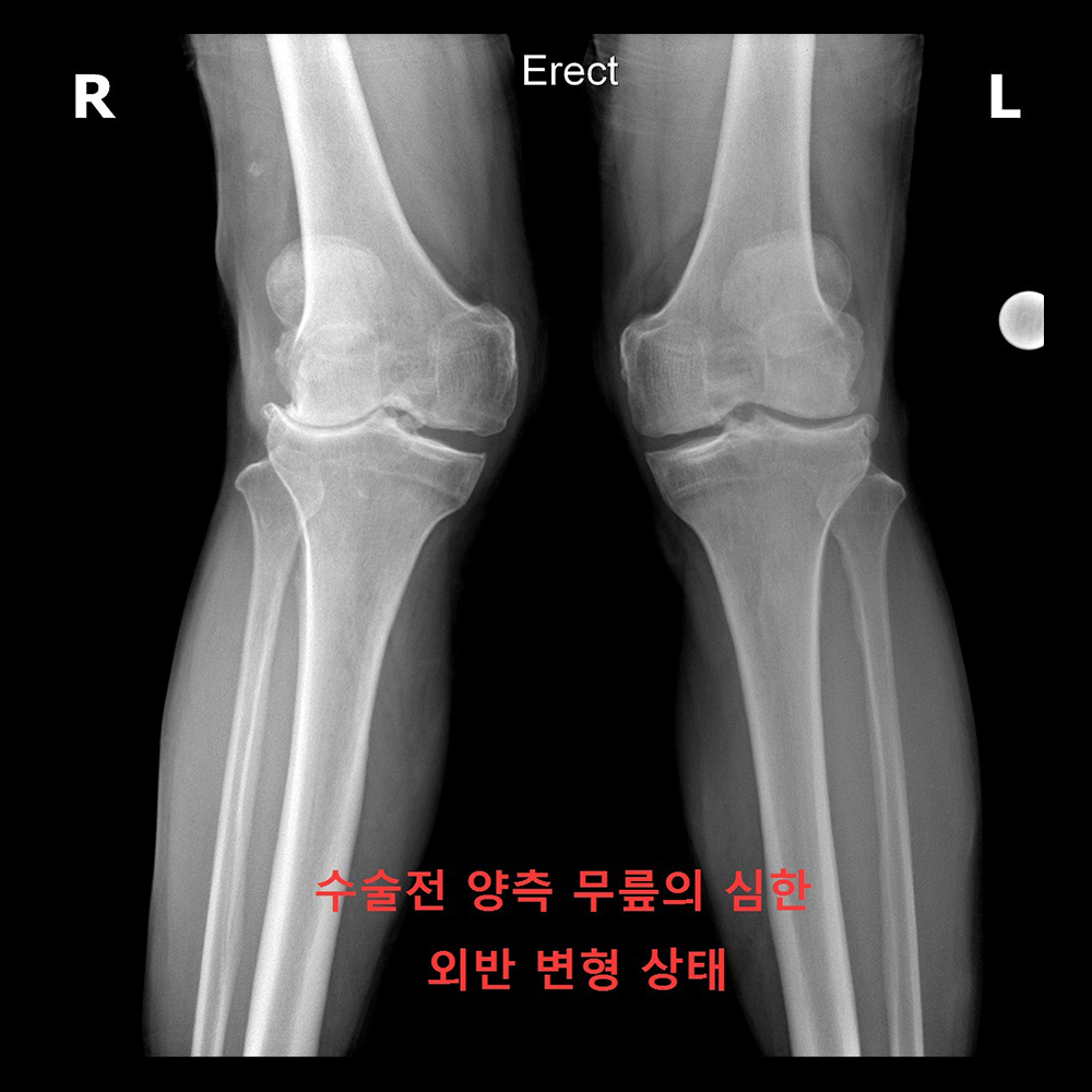 양측 무릎의 심한 외반 변형 상태 수술 전(정면)