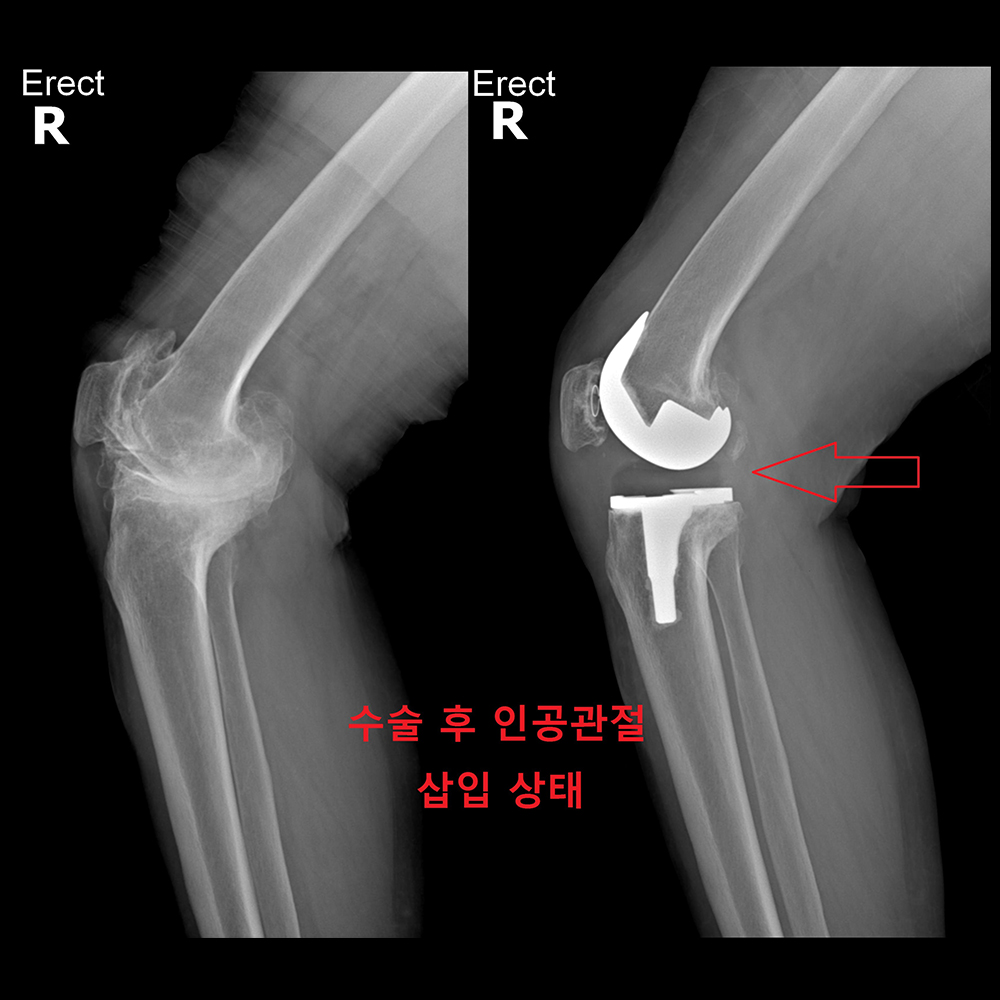 수술 후 인공관절 삽입 상태
