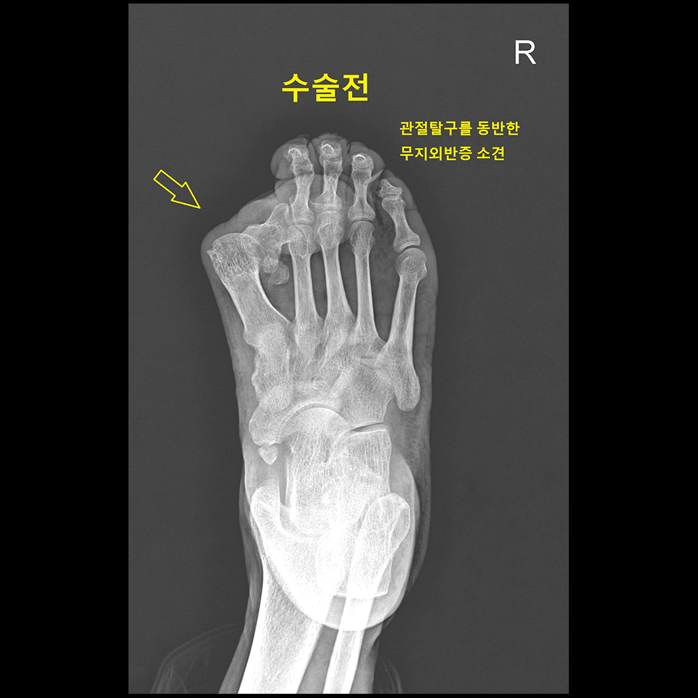외반변형수술 전
