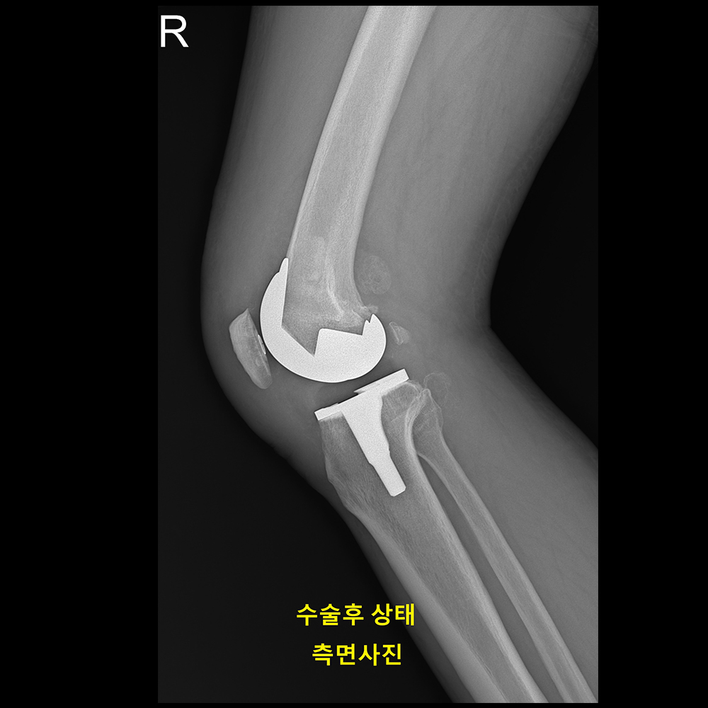 양측 무릎의 심한 외반 변형 상태 수술 전(실제)
