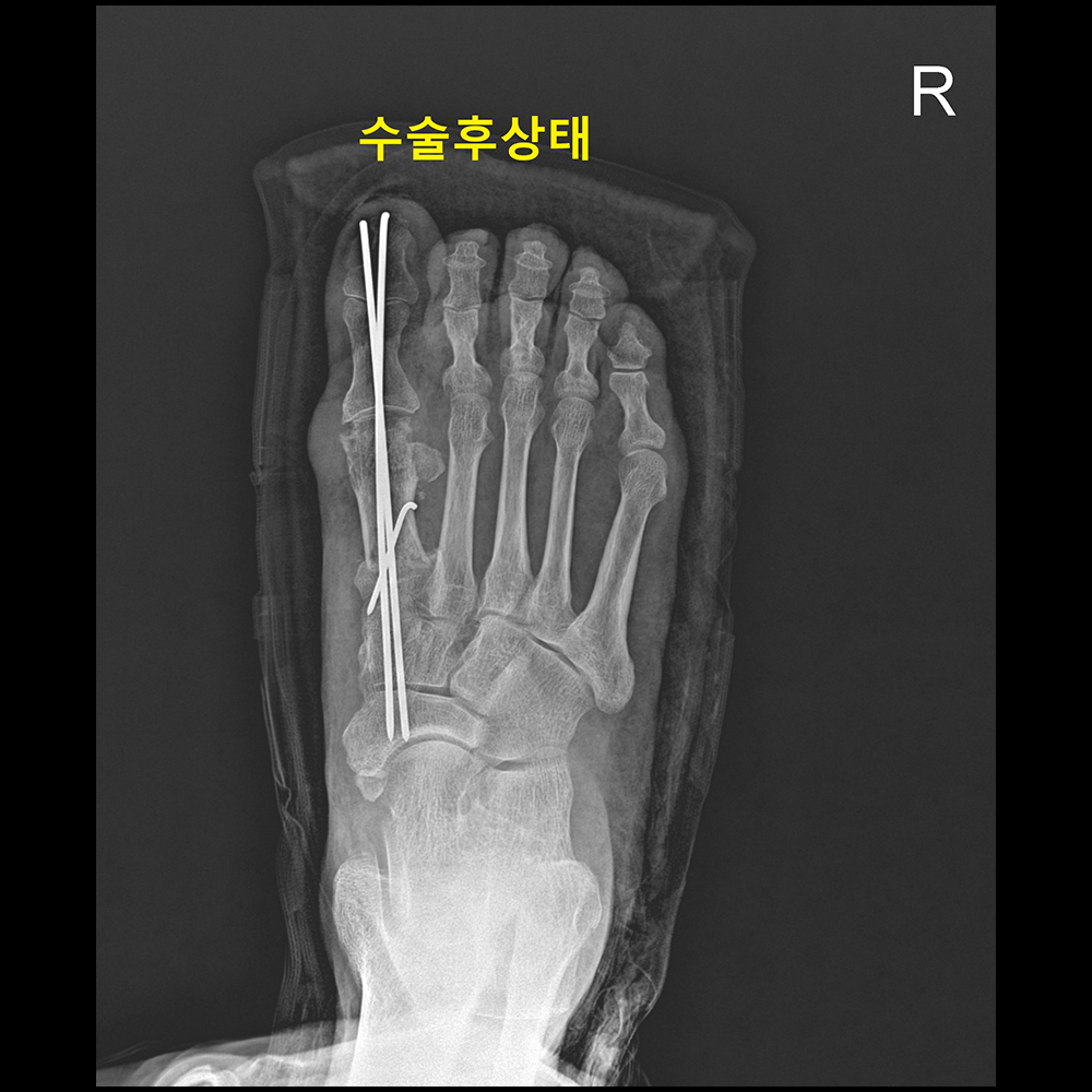 외반변형수술 후