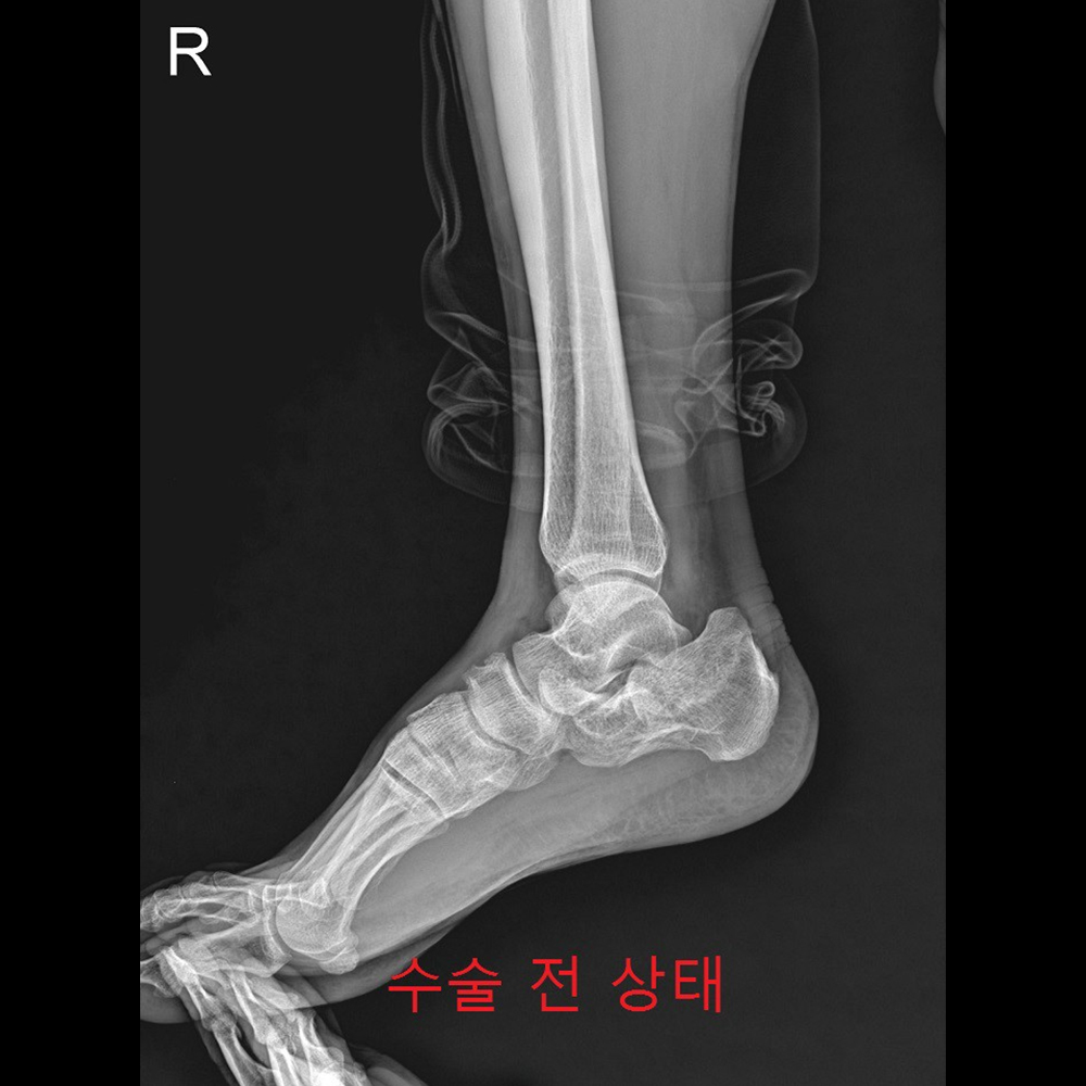 금속판고정형태 수술 전