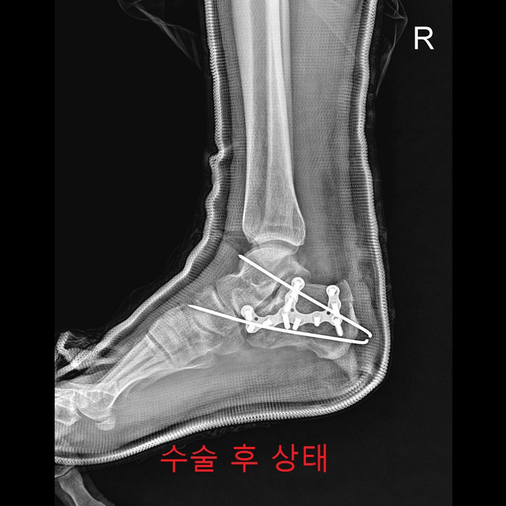 금속판고정형태 수술 후