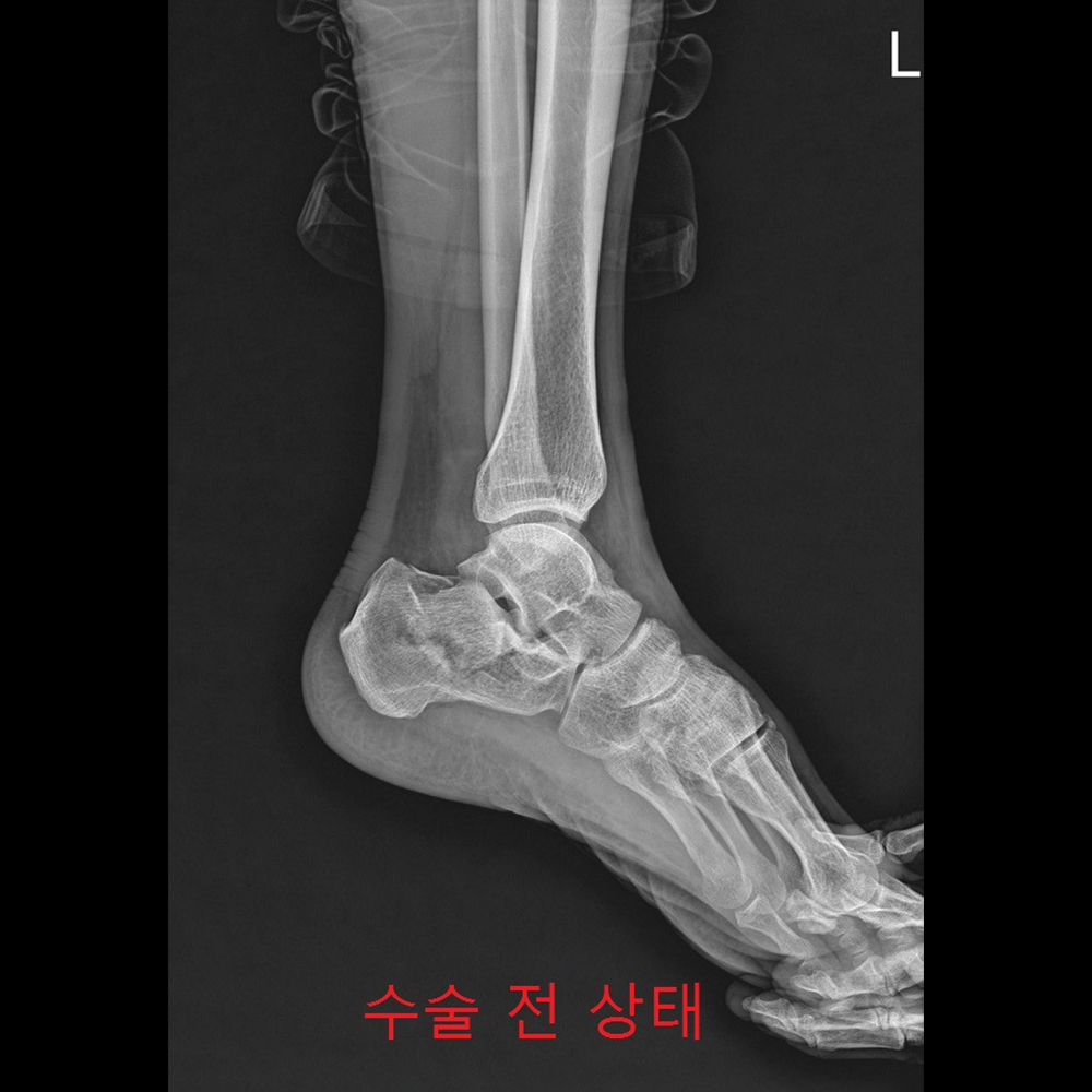 금속판고정형태 수술 전