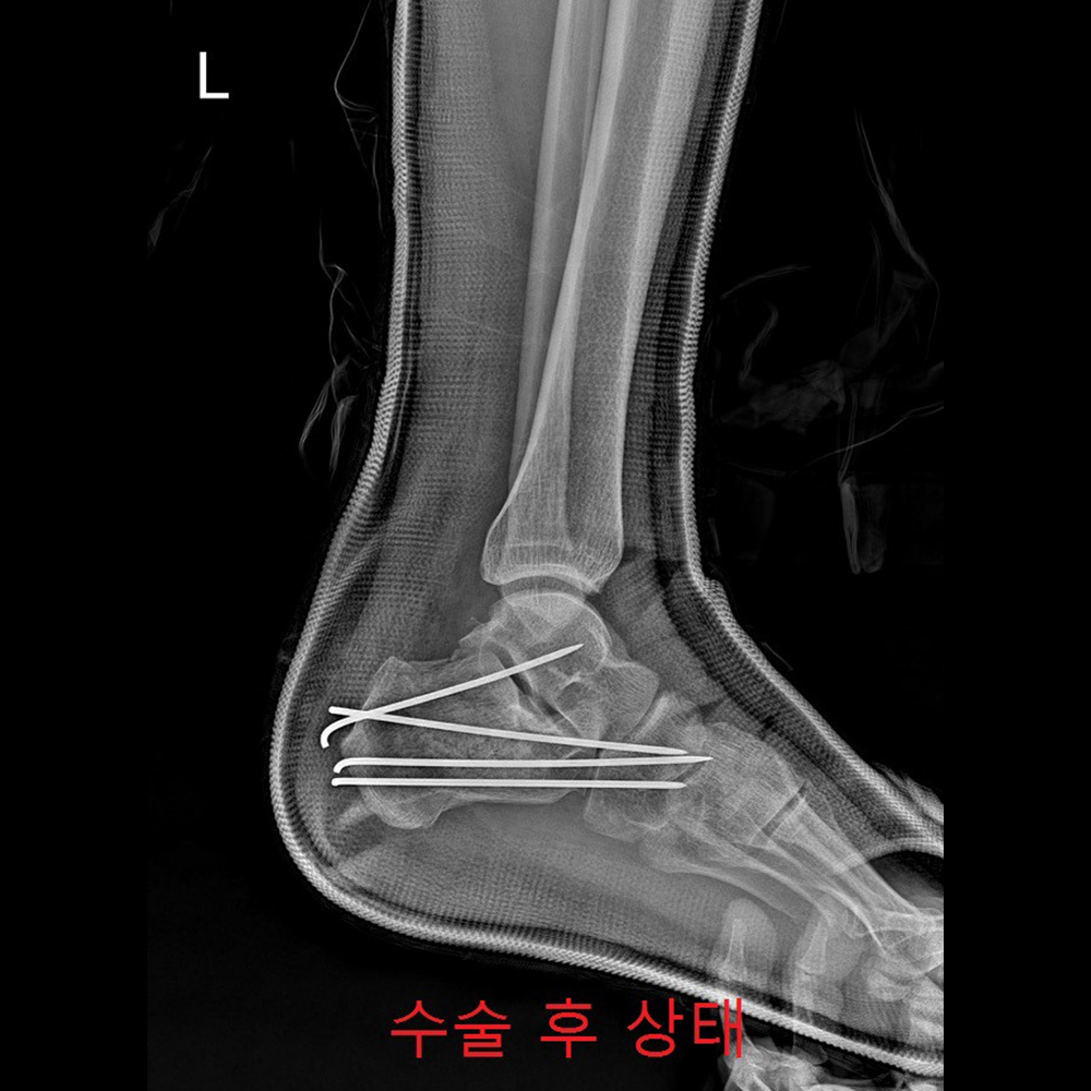 금속판고정형태 수술 후