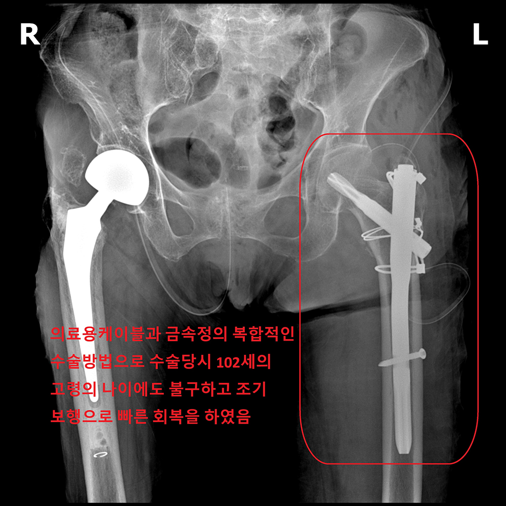 수술 후