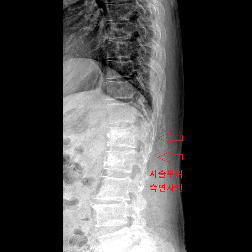 수술 후(측면)
