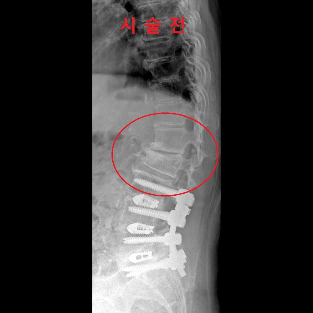 Junctional problem I 수술 전