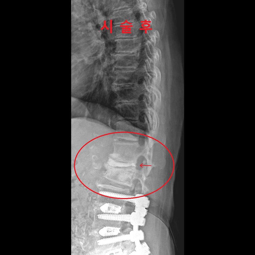 Junctional problem I 수술 후