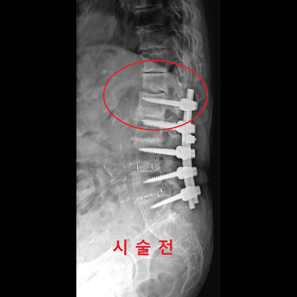 Junctional problem II 수술 전