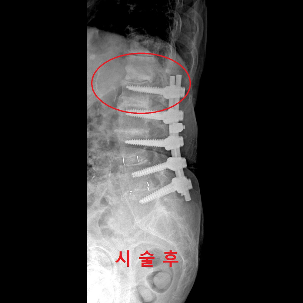 Junctional problem II 수술 후